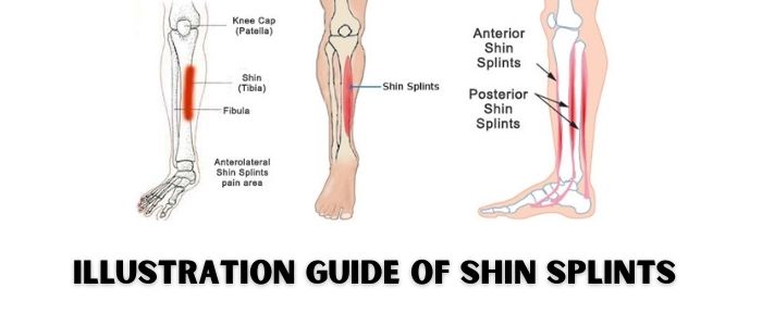 Illustration guide of Shin Splints